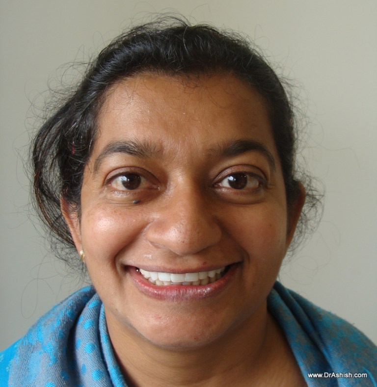 Dental Veneers [Single Visit] in Mumbai Dr. Ashish Shah