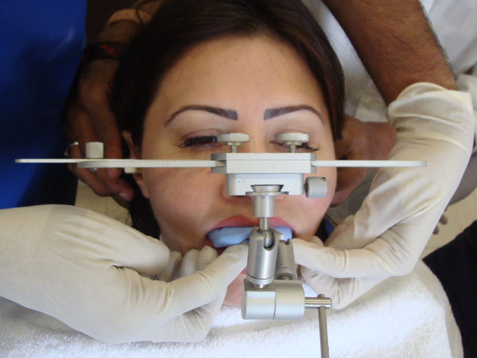 Teeth Aligners For A Patient From the UK Dr. Ashish Shah