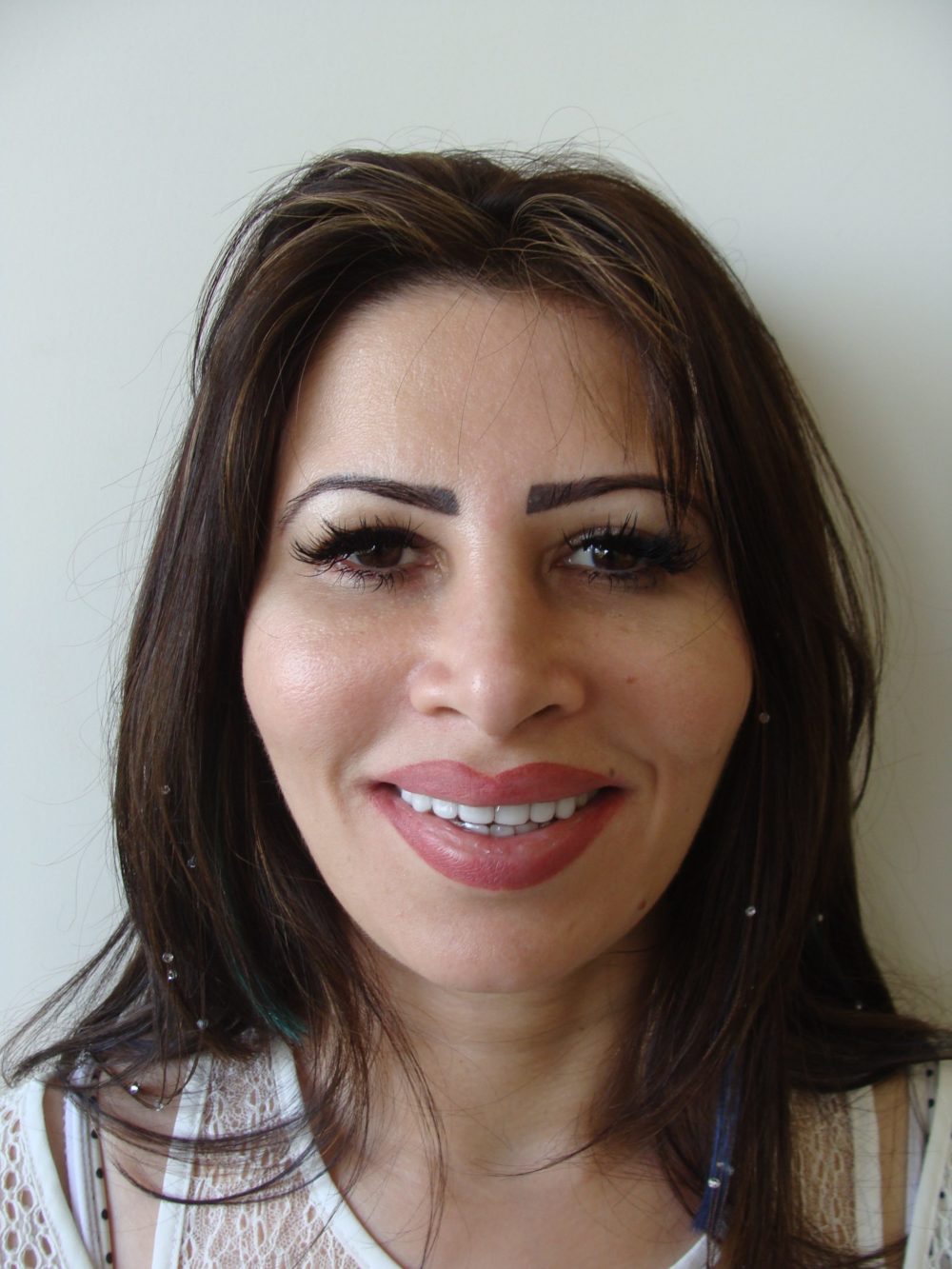 Teeth Aligners For A Patient From the UK Dr. Ashish Shah