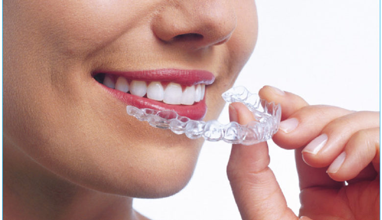 Invisalign Braces