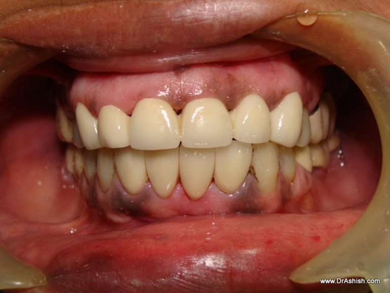 Cosmetic Correction of Flared Teeth Dr. Ashish Shah