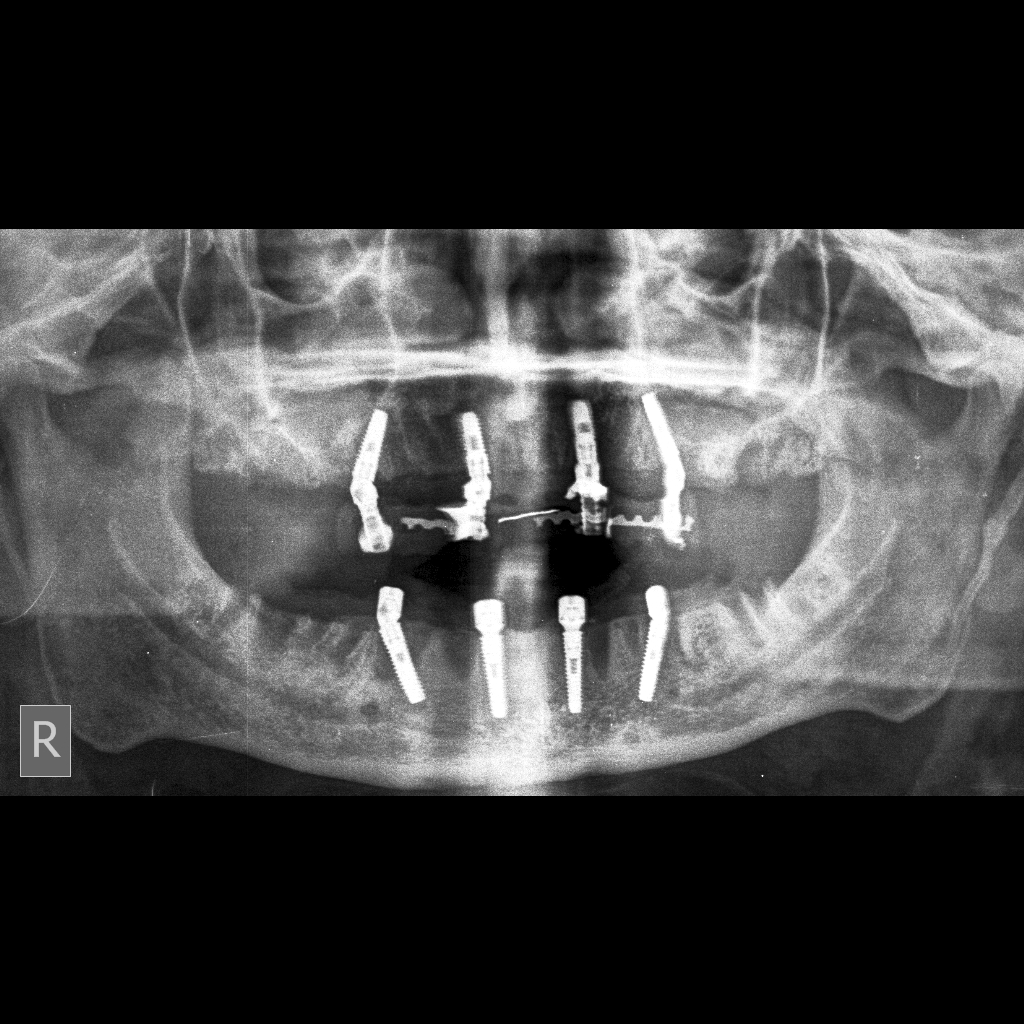 Dental Implants in Mumbai Dr. Ashish Shah