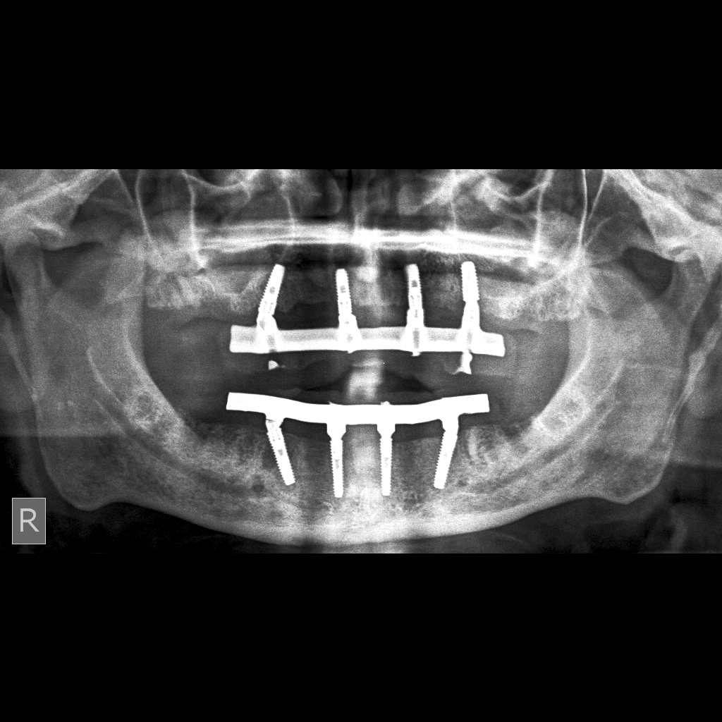 Dental Implants in Mumbai Dr. Ashish Shah