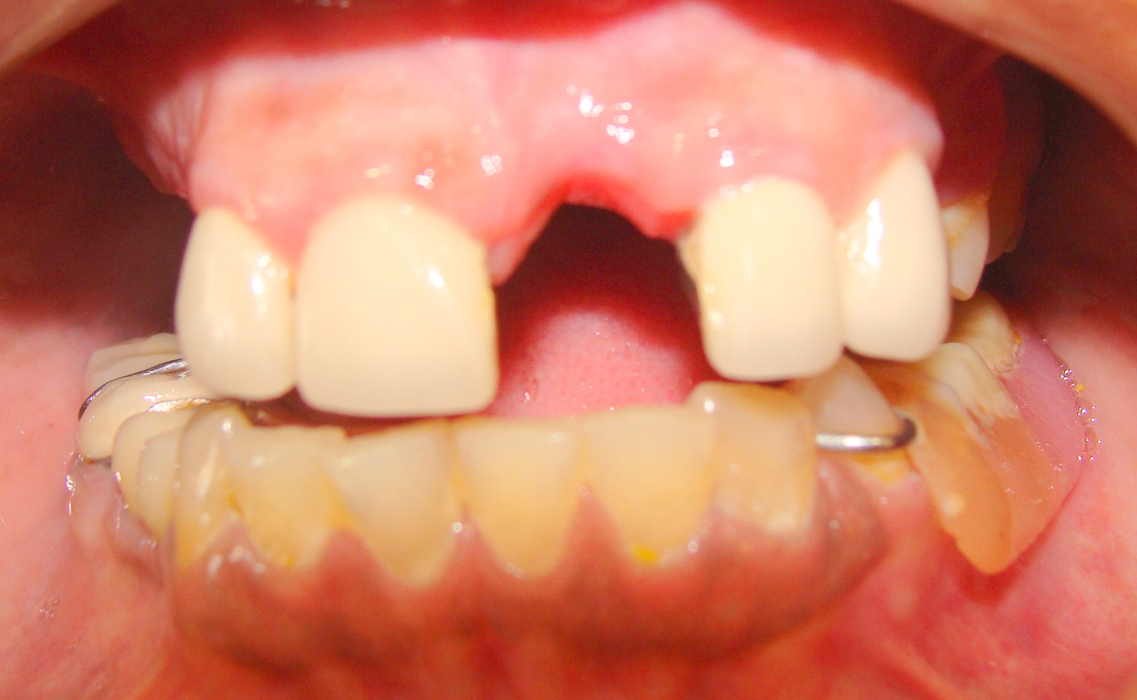 Immediate Replacement of Missing Teeth with Dental ...