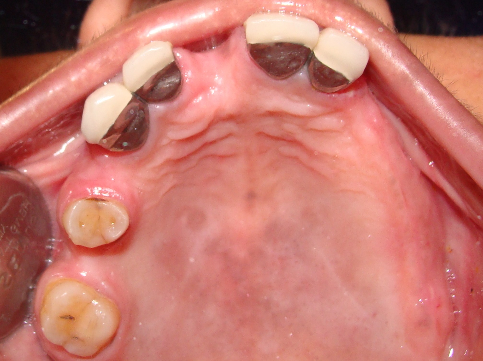Teeth whitening treatment cost in mumbai