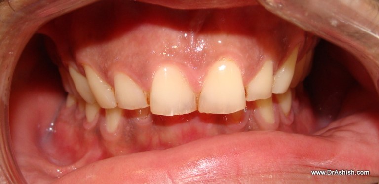 Treatment Of Worn Out Teeth and Gummy Smile with Veneers ...