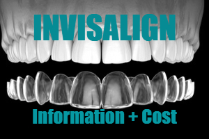 Should I undergo Invisible Aligners-Invisalign Treatment?