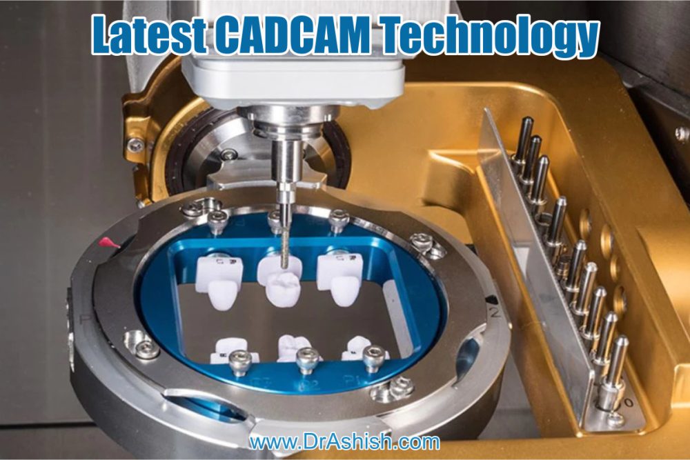 CAD CAM Crowns & Bridges - Dr. Ashish Shah