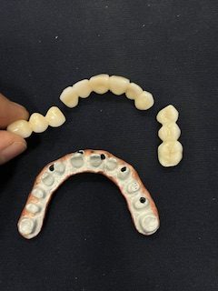 Fractured Implant Bridge Implant Crowns by Dr Ashish Shah