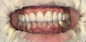 Fractured Implant Bridge Zirconia Crowns by Dr Ashish Shah