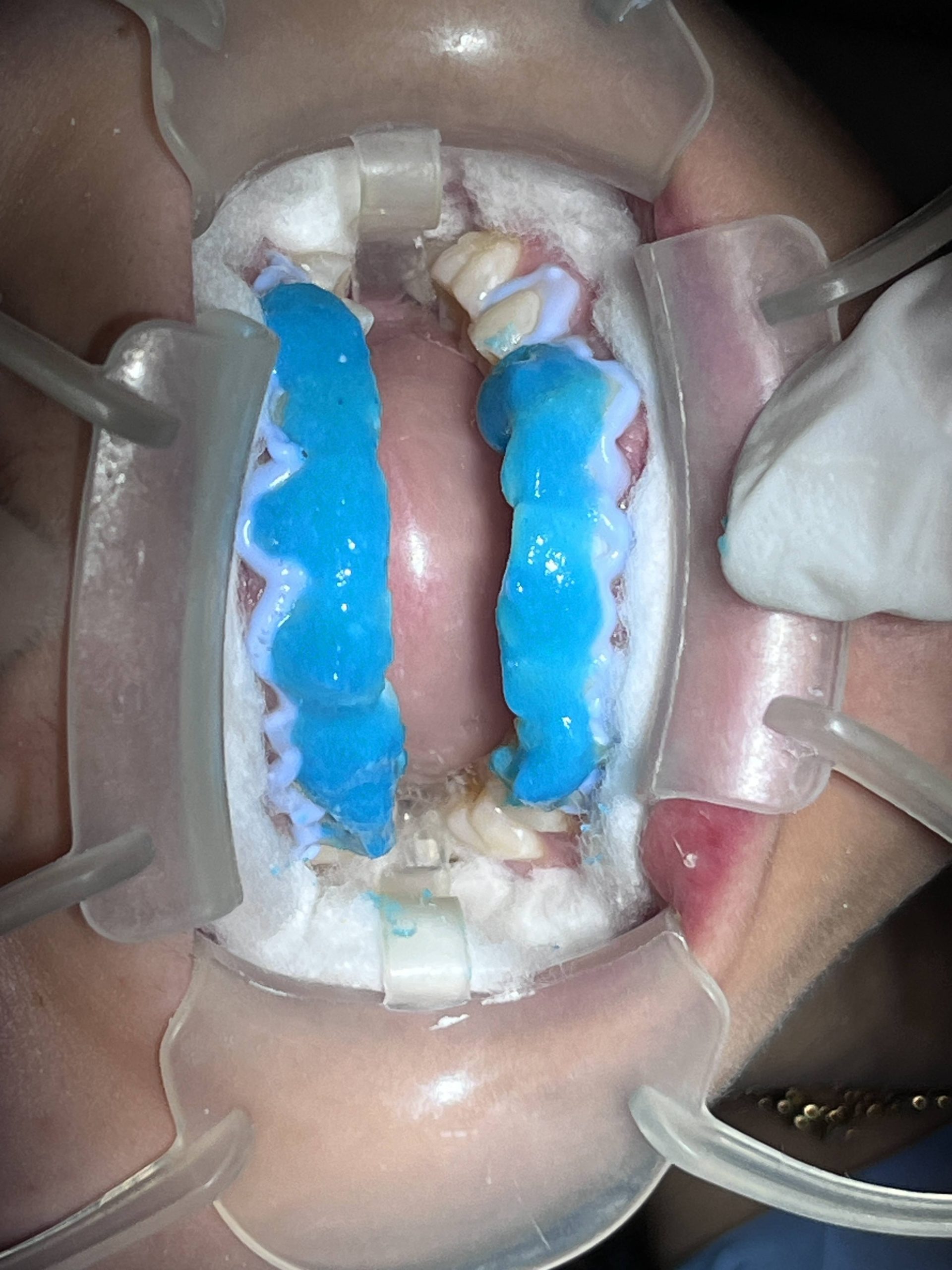 Teeth Bleaching Best Dentist In Mumbai