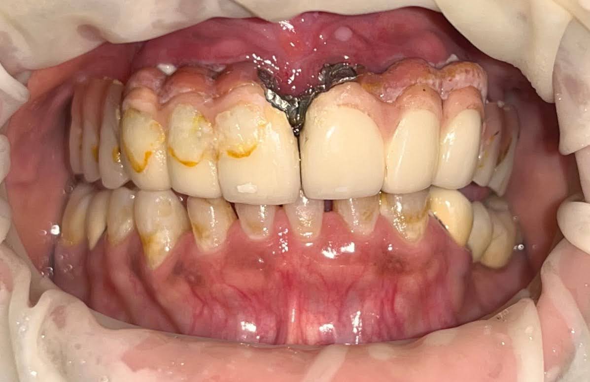 Fractured failing Implant Bridge Zirconia Crowns by Dr Ashish Shah