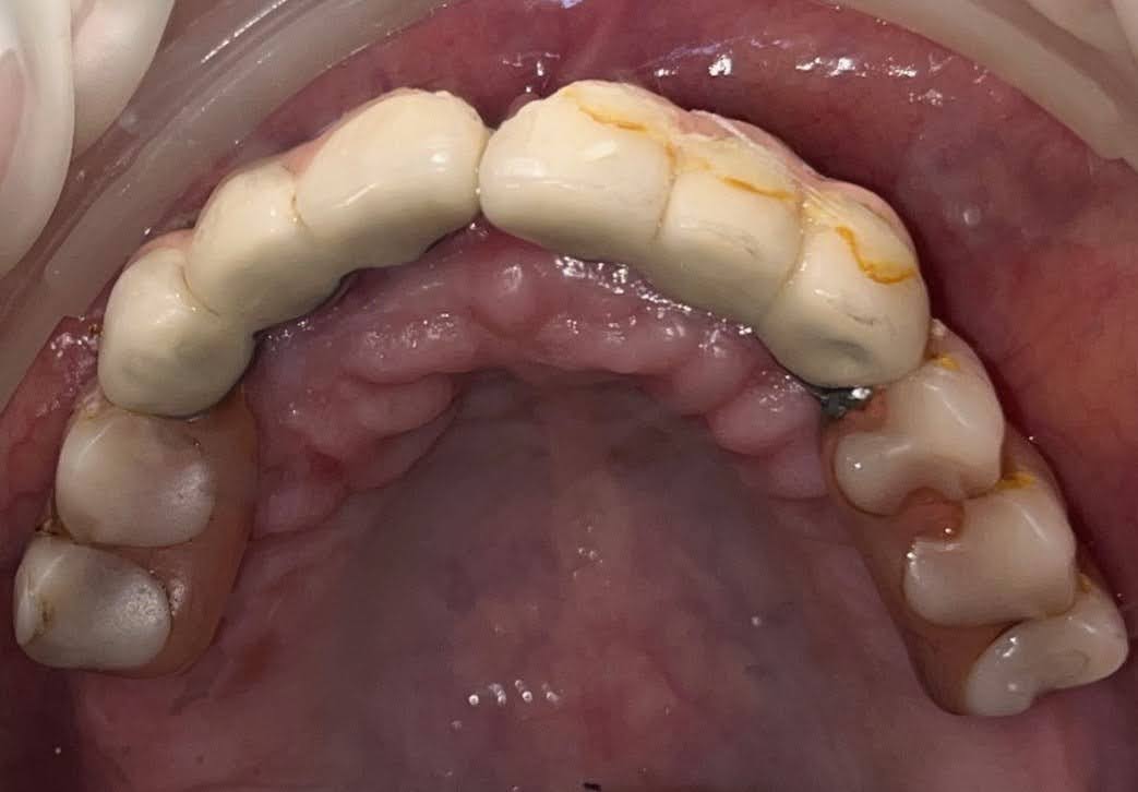 Fractured failing Implant Bridge Zirconia Crowns by Dr Ashish Shah