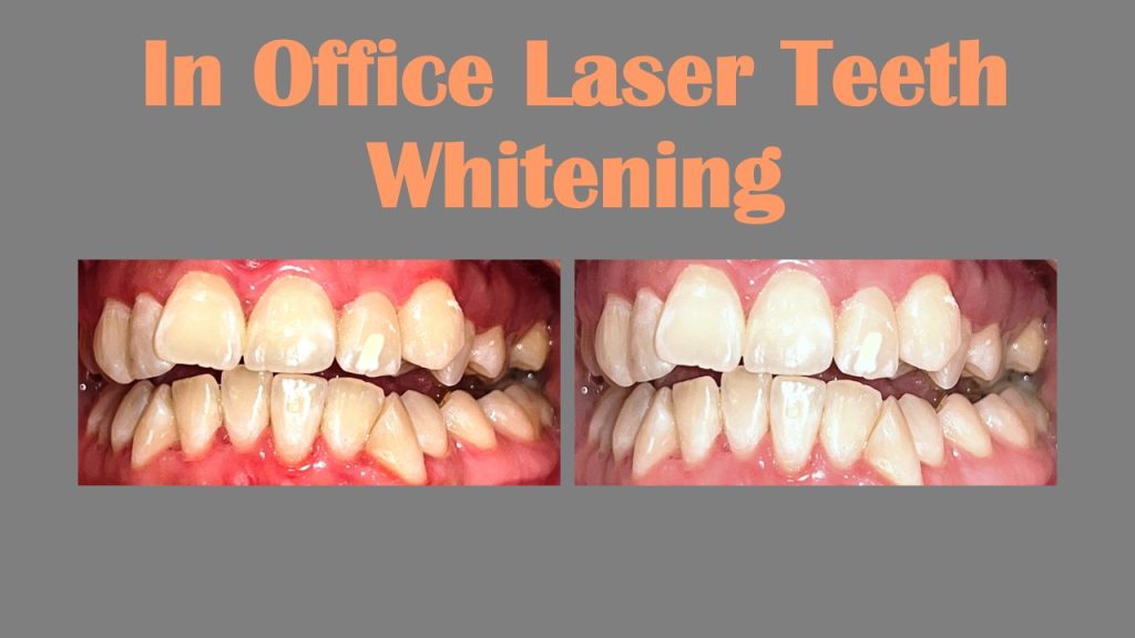 Teeth Whitening by Dr Ashish Shah