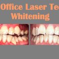 Teeth Whitening by Dr Ashish Shah