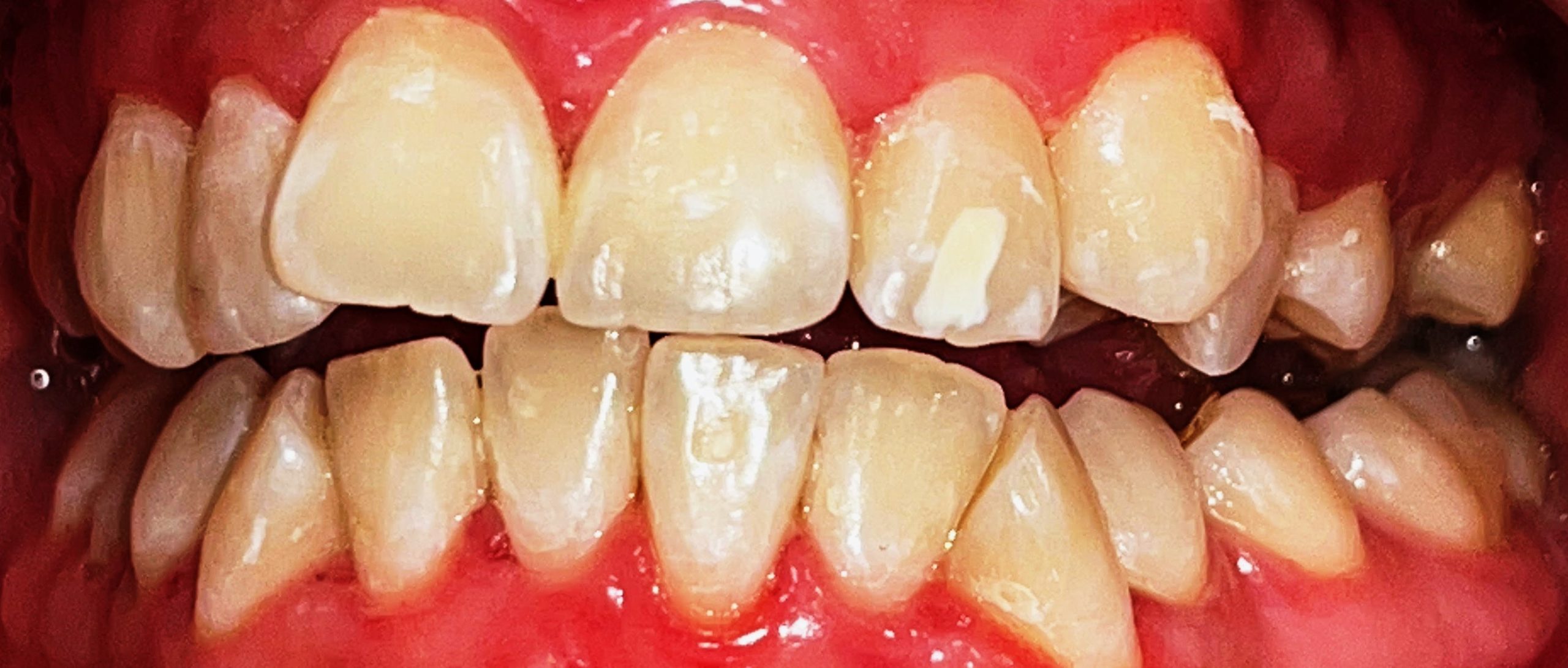 Teeth Whitening-Dr.Ashish Shah