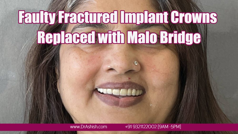Zirconia Crowns by Dr Ashish Shah