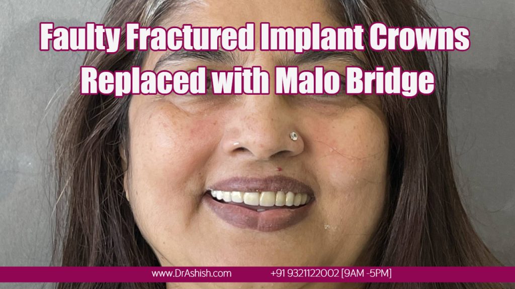 Zirconia Crowns by Dr Ashish Shah