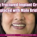 Zirconia Crowns by Dr Ashish Shah