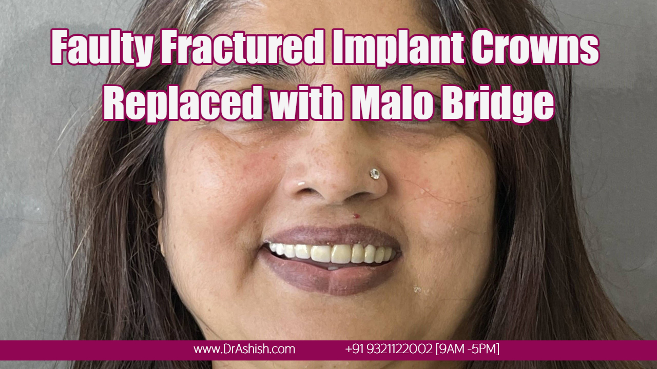Replacing failing Implant Bridge Zirconia Crowns by Dr Ashish Shah