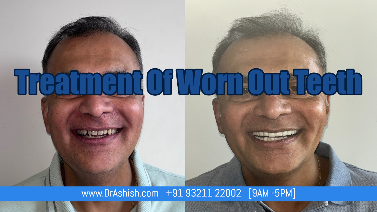 Dental Veneer – Dr Ashish Shah Dentist Near Me-Dr Ashish Shah