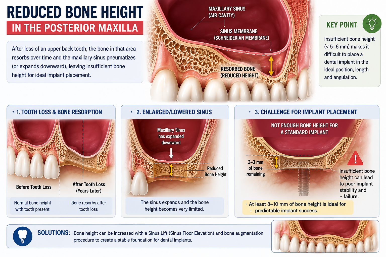 Bone Deficiency in posterior maxilla