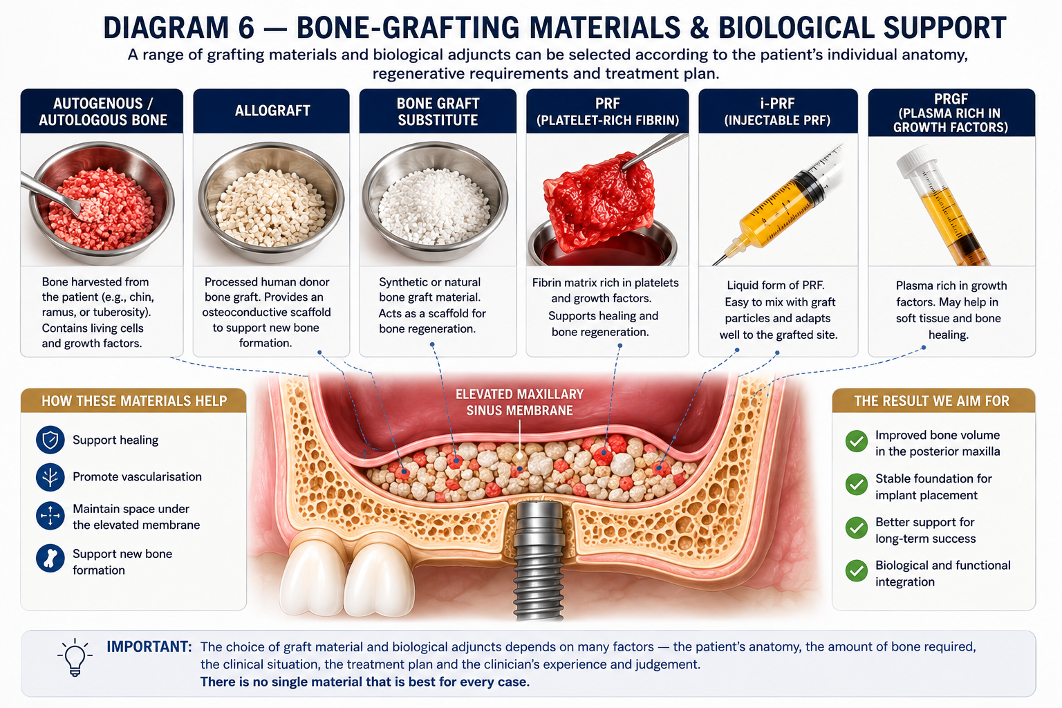 Bone Grafts for Sinus Lift