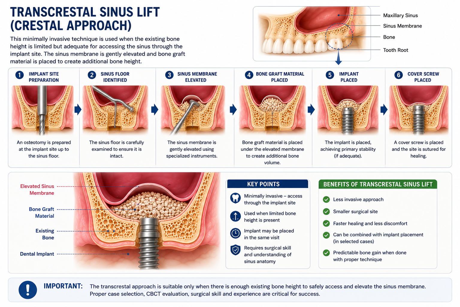 Crestal Sinus Lift
