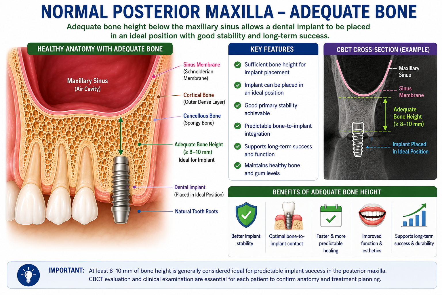 Posterior Maxilla Adequate Bone