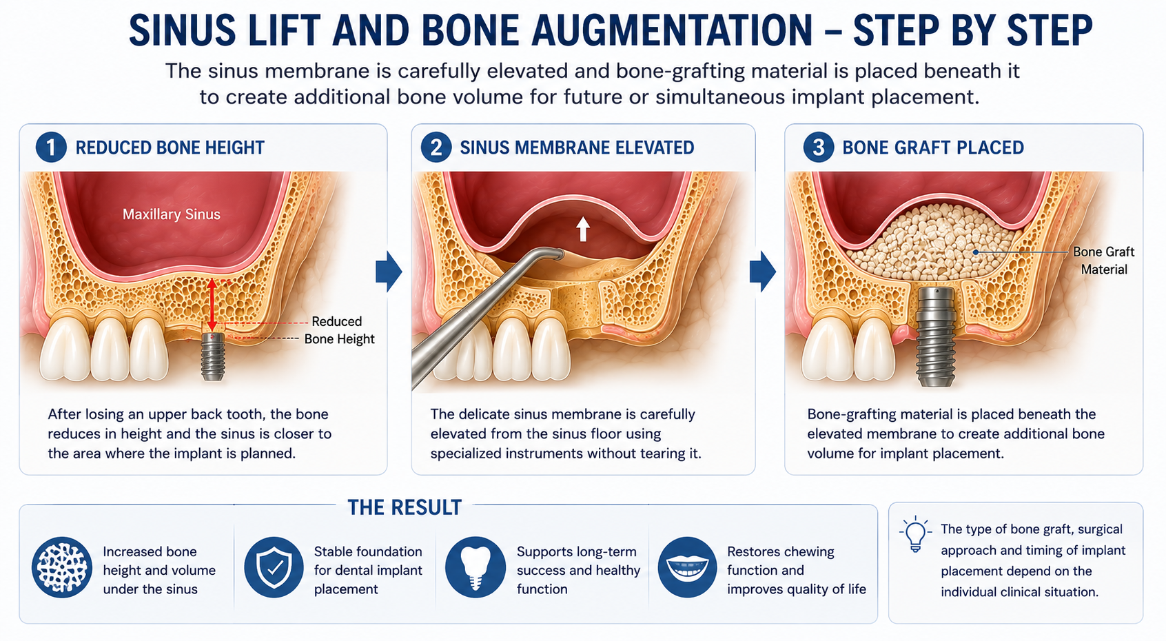 Sinus Lift Step By Step