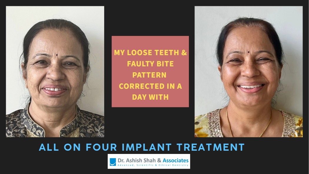 All On 4 Dental Implant Treatment