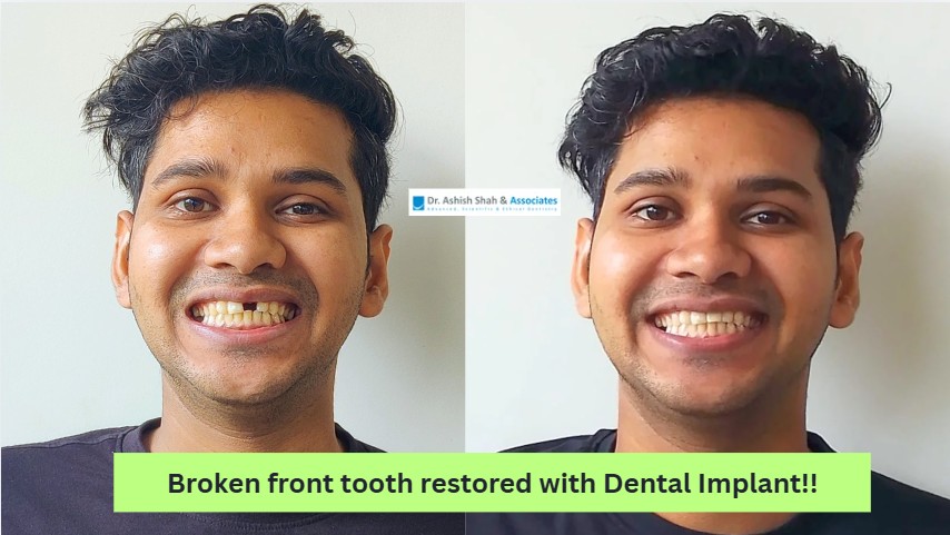 Traumatised Tooth Replaced with Carefully planned immediate implant