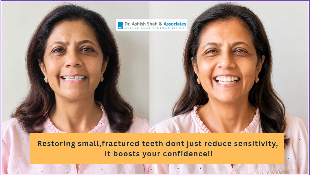 Dental Veneers on worn out teeth